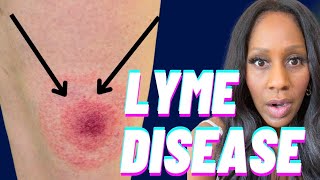 EARLY WARNING SIGNS OF LYME DISEASE You Shouldn’t Ignore A Doctor Explains [upl. by Adnara]