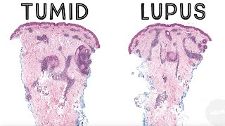 Tumid lupus erythematosus pathology dermpath dermatology dermatopathology USMLE [upl. by Alaet914]