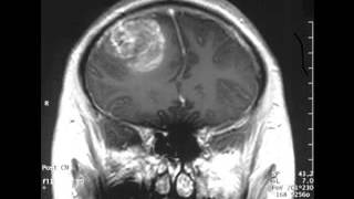 Glioma brain cancer pictures [upl. by Gerdi439]