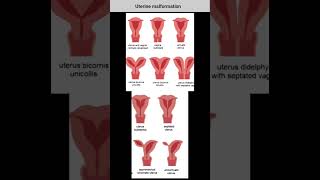 uterine anomalies  arcuate uterus septate uterus unicornuate uterus  bicornuate uterus  uterus [upl. by Cort]