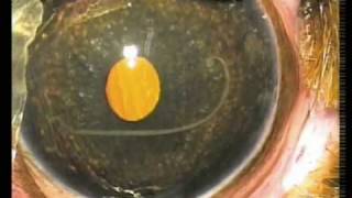 Angiostrongylus nematode worm in eye of puppy  surgical removal [upl. by Sophy554]