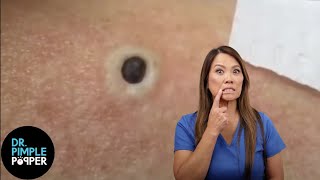 85 Year Old Blackhead Dr Pimple Popper Most Popular Pop of ALL TIME [upl. by Rebmetpes]