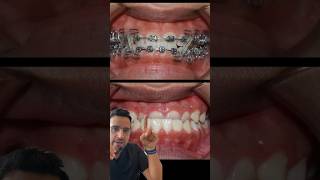 Cas ORTHODONTIE  l’INVERSÉ d’occlusion DENTAIRE [upl. by Pate]