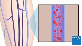 How superficial thrombophlebitis develops [upl. by Colwell]