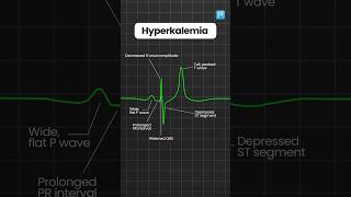 Hyperkalemia and Hypokalemia ECG changes [upl. by Greenleaf]