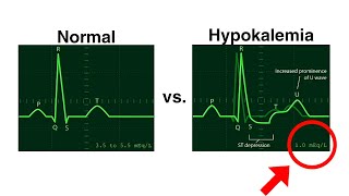 Hypokalemia ECG  Normal vs Hypokalemia  ECG changes in Hypokalemia ecg hypokalemia cardiology [upl. by Burgener]