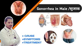 Gonorrhea In Male Treatment। Homeopathic Medicine For Gonorrhea। Gonorrhea Symptoms Cause।Sujak। [upl. by Schuster]