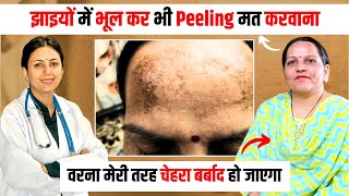 झाइयों में PEELING ke Side Effects se चेहरा काला पड़ गया 🥲  MELASMA REVIEW  Dr Upasana Vohra [upl. by Sivlek]