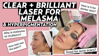 Clear  Brilliant Laser for Melasma Dermatologist Answers FAQs with Before amp After Results [upl. by Nomor375]