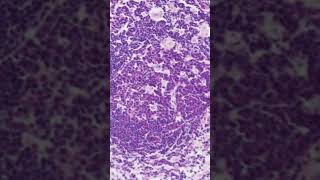 Toxoplasma Lymphadenitis Histology [upl. by Elleneg487]