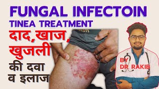 TINEA CORPORISFUNGAL INFECTION TREATMENTदाद खाज खुजली की दवाTINEA INFECTIONKHUJLI DUR KAREN [upl. by Eila719]