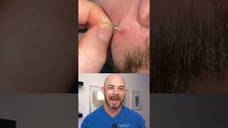 Doctor reacts to slimy pimple patch removal dermreacts doctorreacts pimplepop [upl. by Larena]