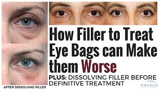 How Under Eye Fillers can Make Prominent Eye Bags Worse and Safely Dissolving Filler [upl. by Jabon]