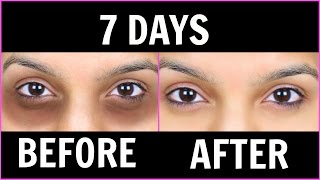 Remove Dark Circles काले घेरों  6 Magical Remedies 100 Effective Anaysa [upl. by Mendive]