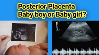 Posterior placenta Baby boy or Baby Girl Gender Prediction Radiology vibes [upl. by Ronda225]