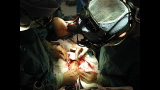 Протезирование Аортального Клапана  Aortic valve replacement [upl. by Mckinney]