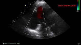 InferoBasal Wall Aneurysm  Mitral Regurgitation [upl. by Piggy]