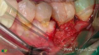 Treatment of Furcation Defect using CGF Sticky bone and rhBMP2 [upl. by Nolyak336]