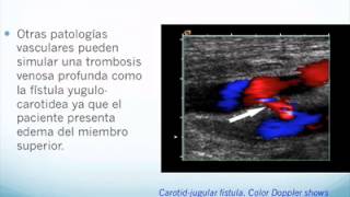 Evaluacion Doppler Miembros Superiores [upl. by Robina]