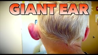 GIANT EAR Allergic Reaction or Infection  Dr Paul [upl. by Gentille]