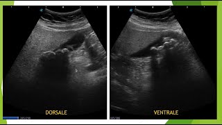Lithiase vésiculaire en échographie le piège des gaz digestifs [upl. by Palladin378]