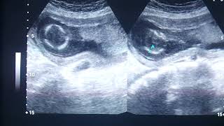 intrauterine fetal deathcystic hygroma hydropsfetalis [upl. by Naillimixam]