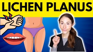 Lichen Planus WHY YOU HAVE IT amp HOW TO TREAT IT [upl. by Bernita359]