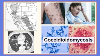 coccidioidomycosis [upl. by Nnylyt]