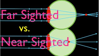 Farsighteness vs Nearsightedness An Explanation [upl. by Cuttie]