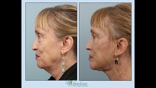 Facelift Experience by Nancy with Dr Edwin Williams [upl. by Risay]