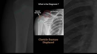 Clavicle fracture Displaced 101 Trauma Xray Upper limb Clavicle and AC jointradiologychannel007 [upl. by Thormora]