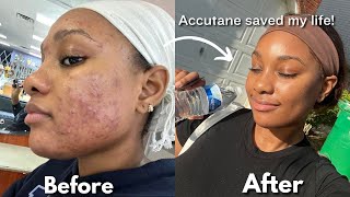 MY 6 MONTH ACCUTANE JOURNEY  side effects purging amp skin care routine  Ice Diallo [upl. by Alegnaoj]