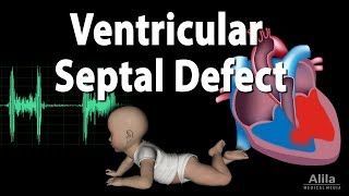 Ventricular Septal Defect Animation [upl. by Eelram]