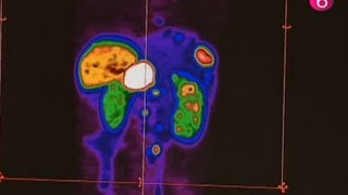 Traitement tumeur neuroendocrinale à Bordet [upl. by Konopka]