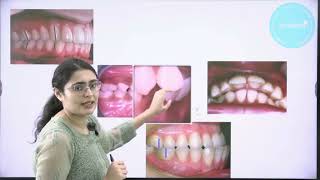 LEARN FOR FREE Classification of Malocclusion Part 2 [upl. by Umeh]