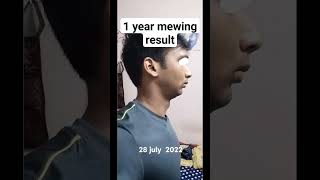 1 year mewing transformation [upl. by Nahtnhoj]