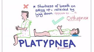 PlatypneaOrthodeoxia Syndrome [upl. by Nicolette]