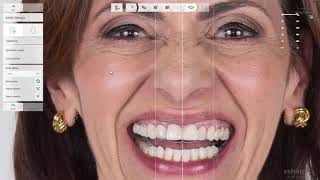 3Shape Smile Design user interface [upl. by Aztinay]