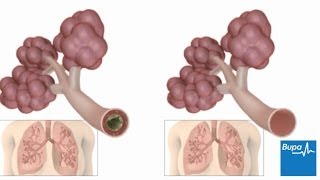 How pneumonia affects the lungs  Bupa Health [upl. by Demaggio]