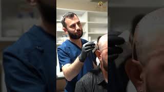 Mr Jose Manuel Luna hair transplant result byhairclinic Hair Transplant Center in Istanbul Turkey [upl. by Eibo]