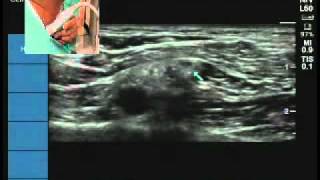 Ultrasound location of Suprascapular nerve [upl. by Yks]