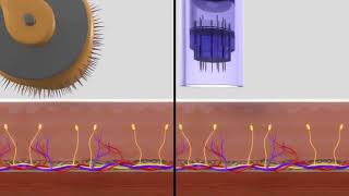 Dermapen v Dermaroller [upl. by Helene]