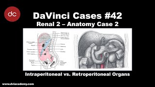 Intraperitoneal vs Retroperitoneal Hemorrhage DaVinciCases Renal 2  Anatomy Case 2 [upl. by Elsbeth]