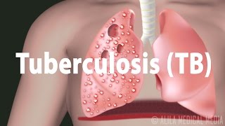 Tuberculosis TB Progression of the Disease Latent and Active Infections [upl. by Aztinad]