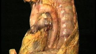 AclandAnatomycom Aclands Video Atlas of Human Anatomy Aortic Arch [upl. by Akinek]