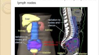 Cervix Cancer and Radiation [upl. by Arahk]