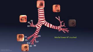 Mastering Bronchoscopy for Thoracic Surgery Chapter 1 [upl. by Lodge]