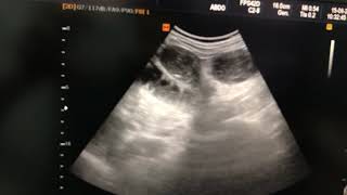 Paralytic ileus ultrasound [upl. by Sartin]