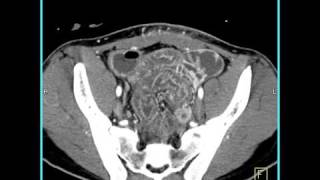 Abdomen Small Bowel EnteritisSeries of coronal sagittal volume rendered and MIP images4 of 6 [upl. by Krusche]