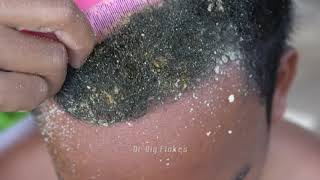 HUGE DANDRUFF  HUGE FLAKE  Treating scalp psoriasis removal no more in lazy mans head 36 [upl. by Aneles]